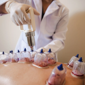 cupping-hijama